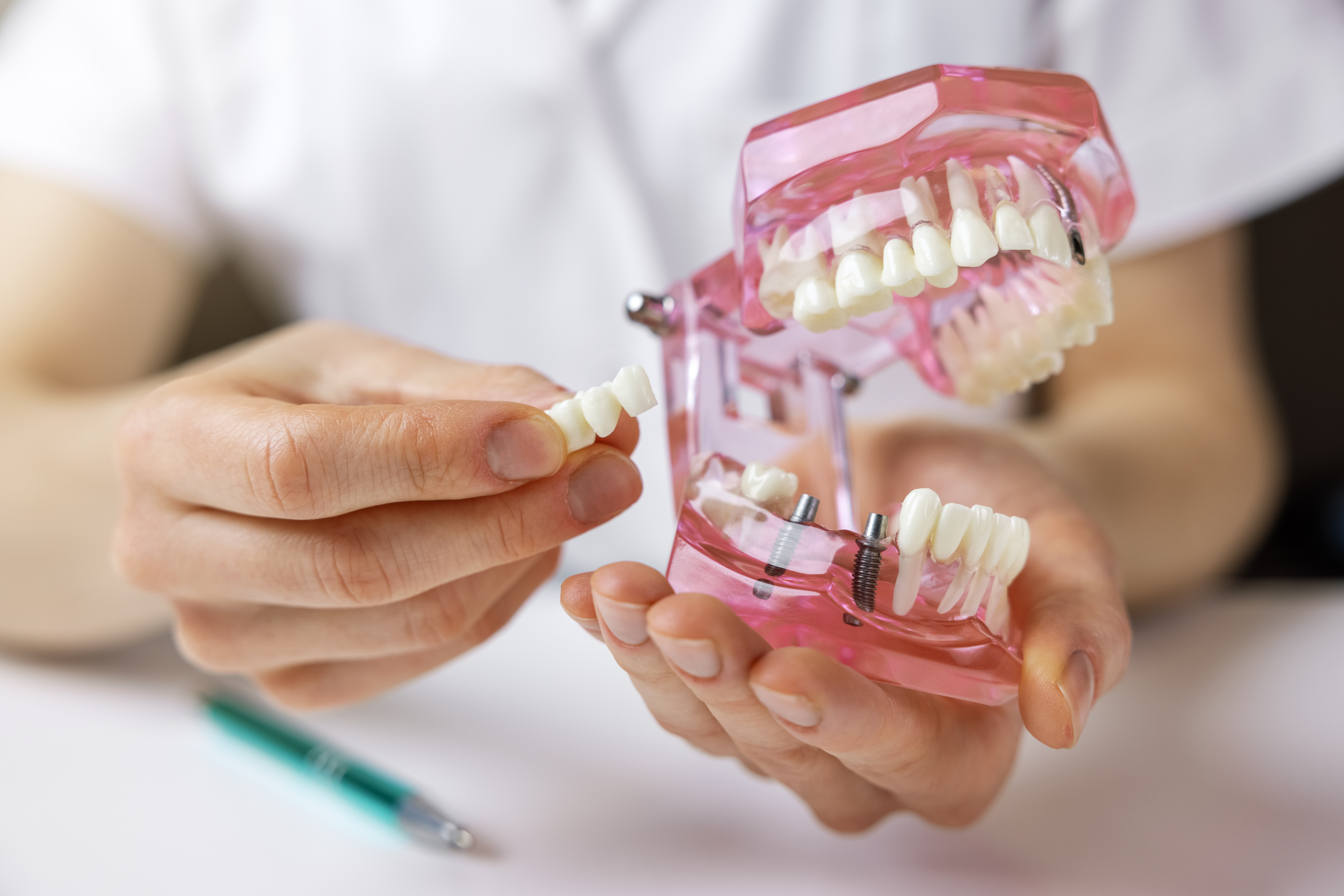 dental implants in Bloomington